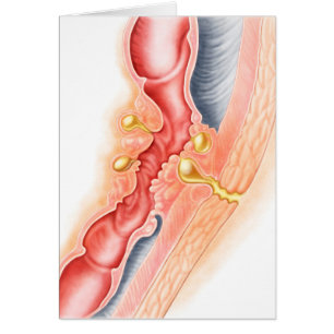 Development Of Fistula