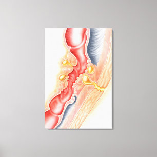 Development Of Fistula Canvas Print
