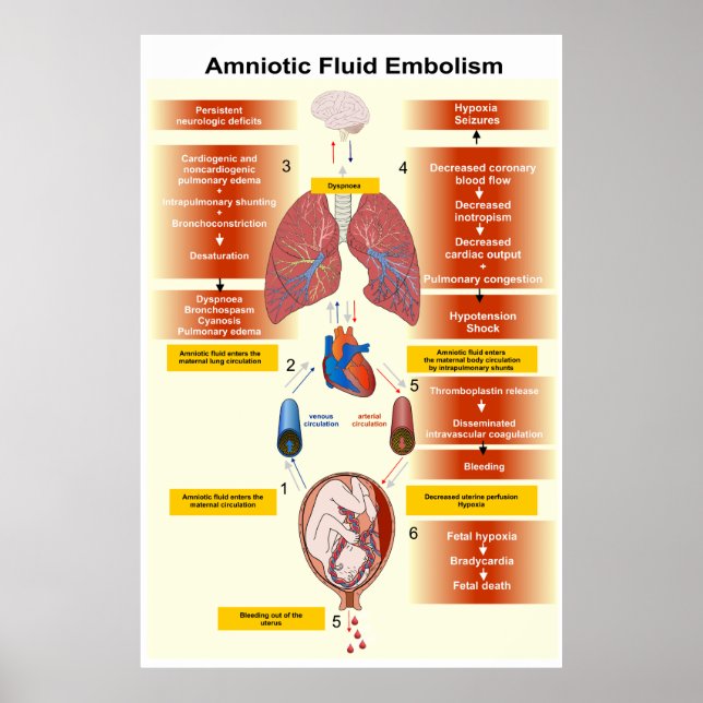 Diagram of an Amniotic Fluid Embolism AFE Poster (Front)