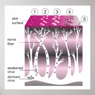 Diagram of the Progression of Shingles on Skin Poster