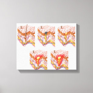 Different Types Of Acne Canvas Print