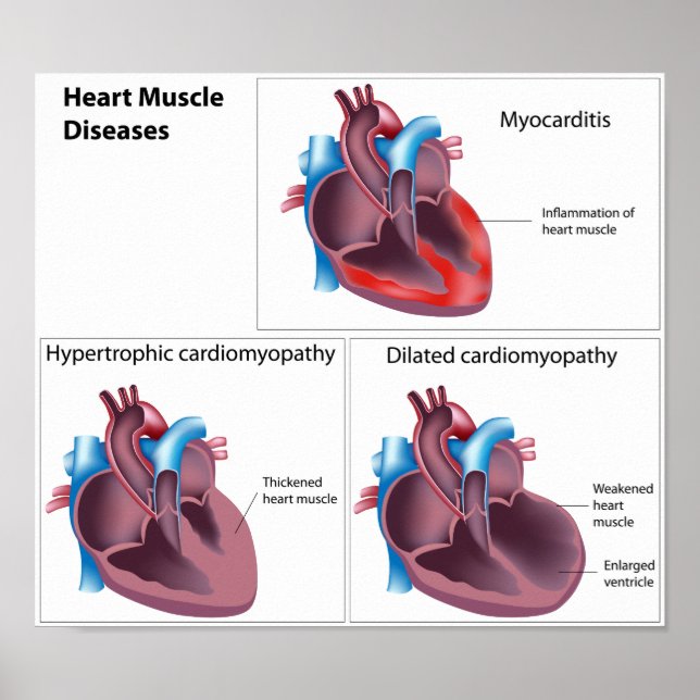 Diseases of the Heart Muscle Poster (Front)