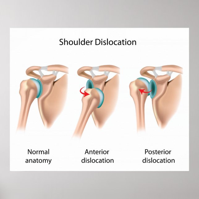 Dislocated shoulder Poster (Front)