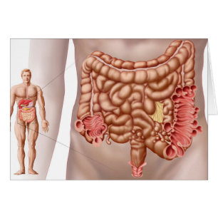 Diverticulitis In The Descending Colon Region