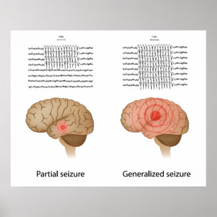 EEG in partial and generalised epilepsy Poster