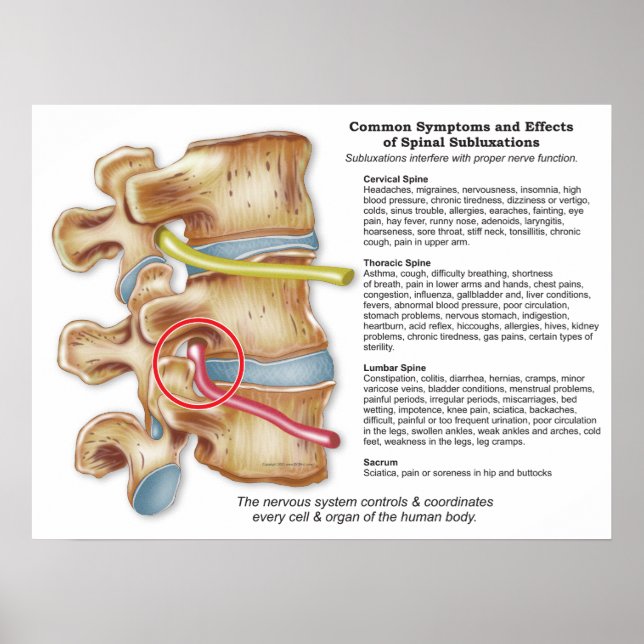 Effects of Spinal Subluxation Chiropractic Poster (Front)