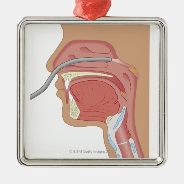 Endoscopy of the Nose Metal Tree Decoration (Front)