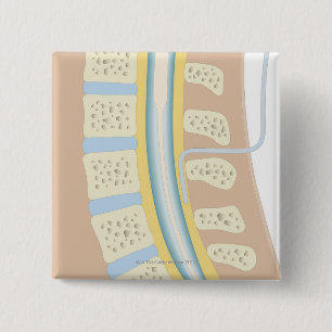 Epidural Anaesthesia 15 Cm Square Badge