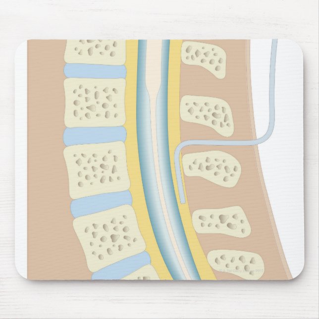 Epidural Anaesthesia Mouse Pad (Front)