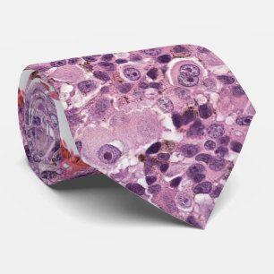 Epithelioid uveal melanoma tie