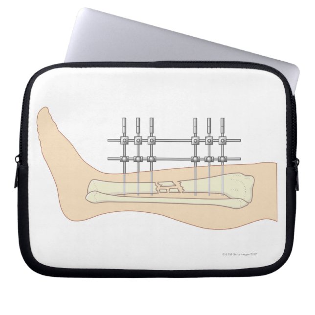 External Fixator Laptop Sleeve (Front)