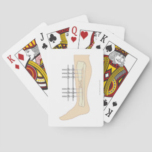 External Fixator Playing Cards