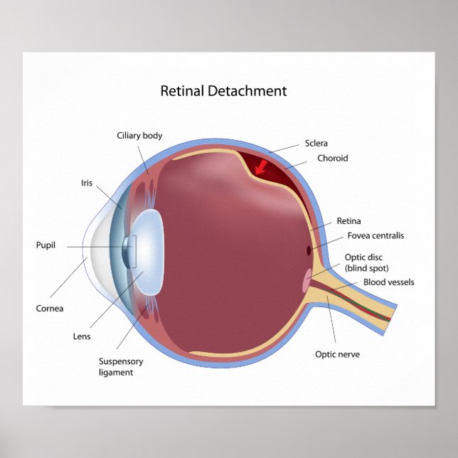 Eye retinal detachment  Poster (Front)