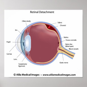 Eye retinal detachment  Poster