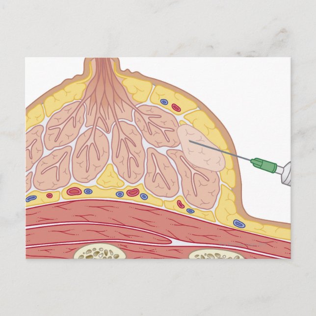 Fine Needle Aspiration Postcard (Front)