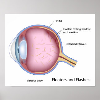 eye drawing floaters Posters Diseases Eye  Zazzle.co.nz