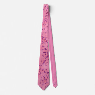 Fuchs Dystrophy Tie
