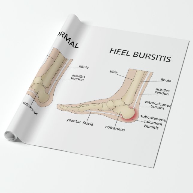 Haglund's deformity wrapping paper (Unrolled)