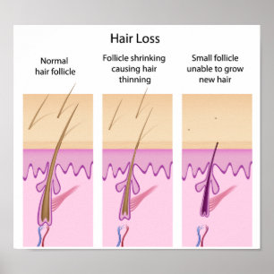 Hair loss process Poster