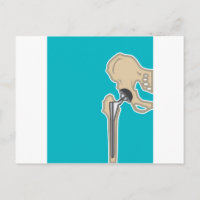 Hip Joint Replacement