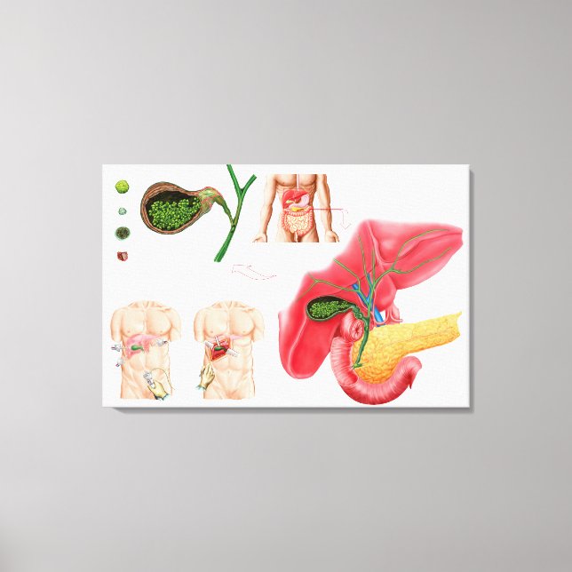 Illustration Depicting Cholecystectomy Canvas Print (Front)