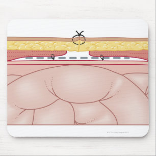 Illustration of a Hernia Mouse Pad