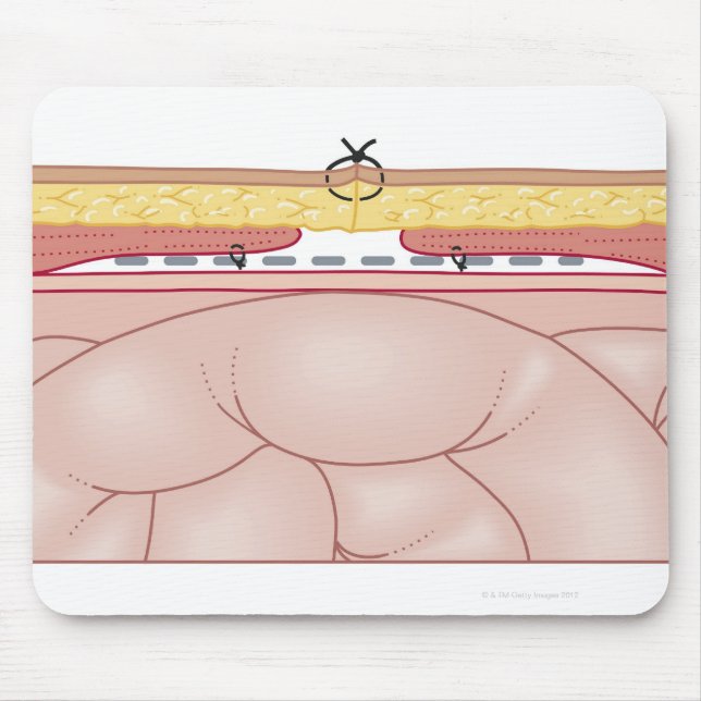Illustration of a Hernia Mouse Pad (Front)