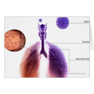 Illustration of an asthma attack from pollen