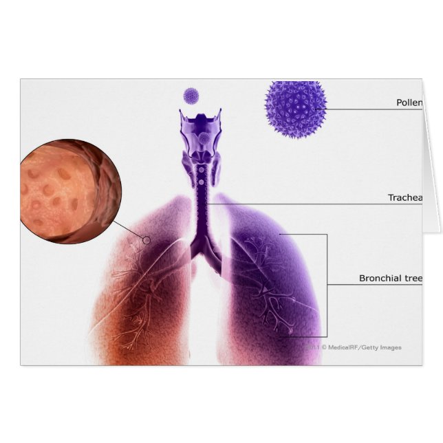 Illustration of an asthma attack from pollen (Front Horizontal)