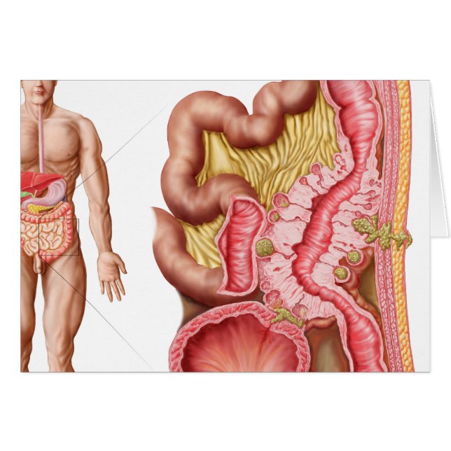 Illustration Of Diverticulosis In The Colon (Front Horizontal)