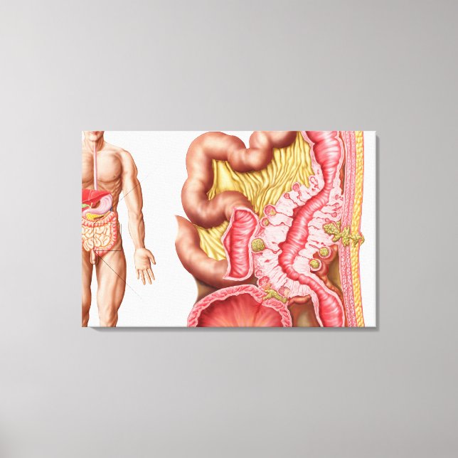 Illustration Of Diverticulosis In The Colon Canvas Print (Front)