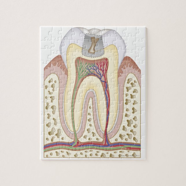 Illustration of Tooth Decay Jigsaw Puzzle (Vertical)