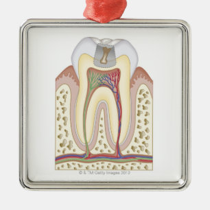 Illustration of Tooth Decay Metal Tree Decoration