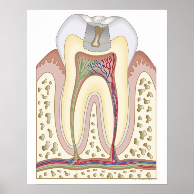 Illustration of Tooth Decay Poster (Front)