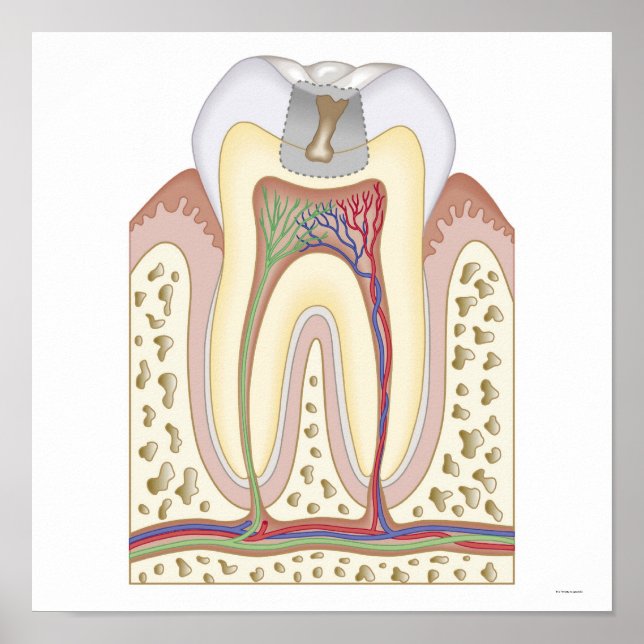 Illustration of Tooth Decay Poster (Front)