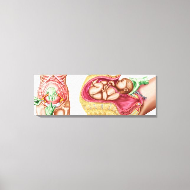Illustration Showing Caesarean Delivery Of Foetus Canvas Print (Front)
