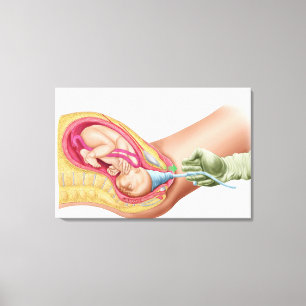 Illustration Showing Delivery Of Foetus 1 Canvas Print