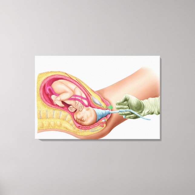 Illustration Showing Delivery Of Foetus 1 Canvas Print (Front)