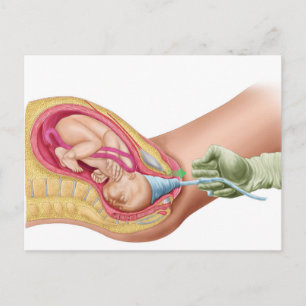 Illustration Showing Delivery Of Foetus 1 Postcard