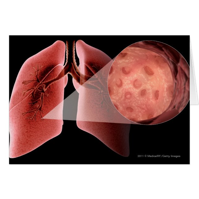 Inflammed airway during an asthma attack (Front Horizontal)