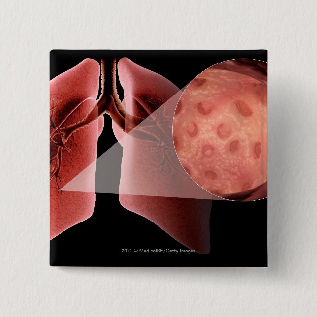 Inflammed airway during an asthma attack 15 cm square badge (Front)
