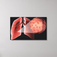 Inflammed airway during an asthma attack