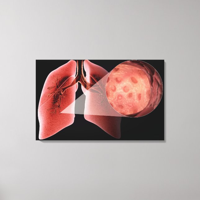 Inflammed airway during an asthma attack canvas print (Front)