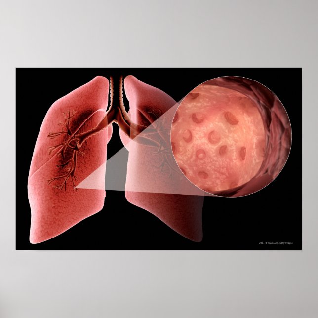 Inflammed airway during an asthma attack poster (Front)