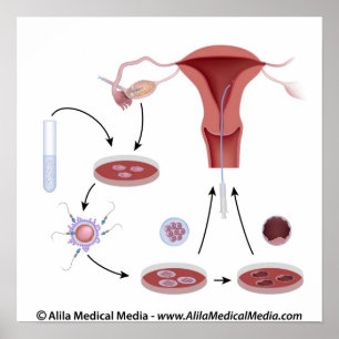 IVF procedure unlabeled diagram. Poster
