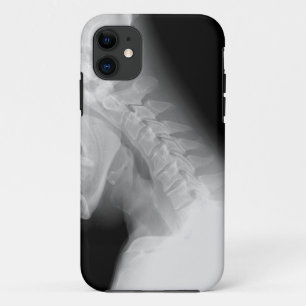 Jaw and Spine X Ray IPhone Case