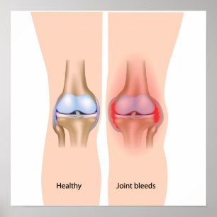 Joint bleeds in haemophilia Poster