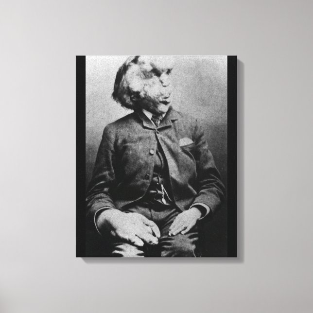 Joseph "John" Merrick The Elephant Man from 1889 Canvas Print (Front)