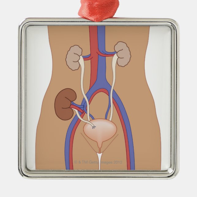 Kidney Transplant Metal Tree Decoration (Front)