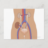 Kidney Transplant